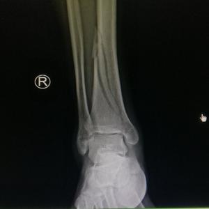 胫骨骨折二次手术视频 西瓜视频